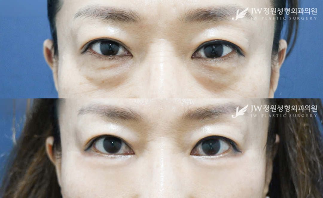 Lower blepharoplasty before and after photo