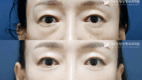 Lower blepharoplasty before and after photo