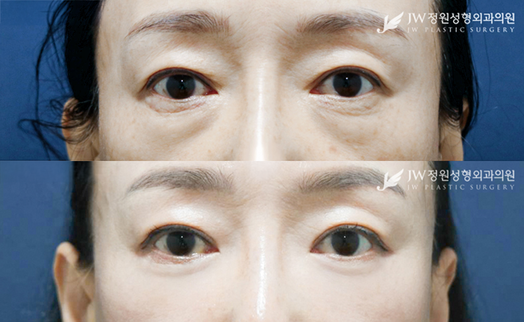 Lower blepharoplasty before and after photo