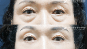 Lower blepharoplasty before and after photo