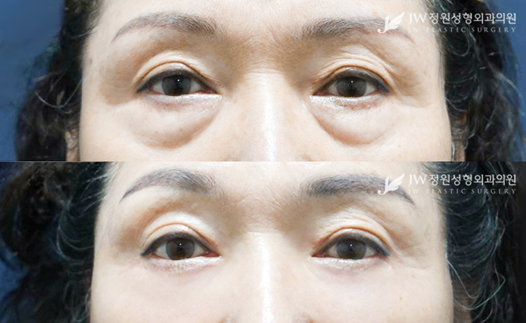 Lower blepharoplasty before and after photo